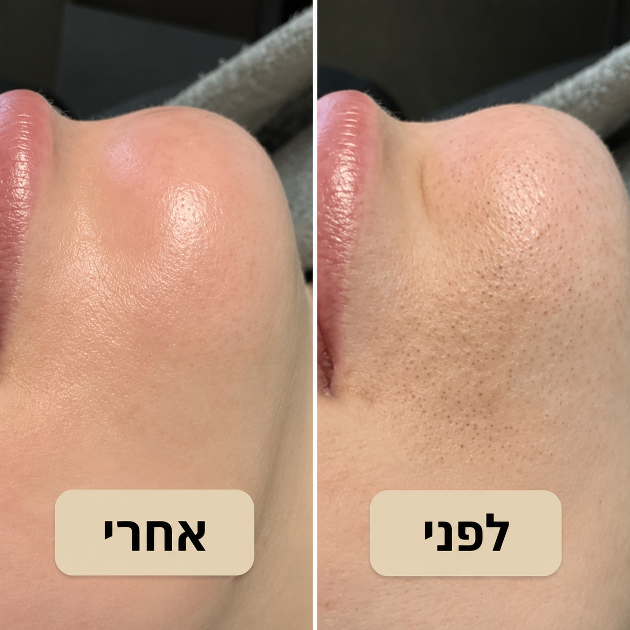 Patchiv™ גולד פיל שוט